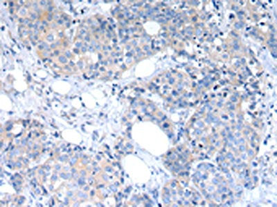 The image on the left is immunohistochemistry of paraffin-embedded Human breast cancer tissue using RAB2A Antibody(RAB2A Antibody) at dilution 1/30, on the right is treated with synthetic peptide. (Original magnification: ×200)Rabbit anti-Human RAB2A Polyclonal Antibody