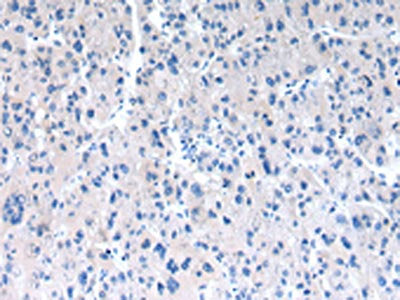 The image on the left is immunohistochemistry of paraffin-embedded Human liver cancer tissue using the antibody Antibody) at dilution 1/30, on the right is treated with synthetic peptide. (Original magnification: ×200)Rabbit anti-Human RAB2A Polyclonal Antibody