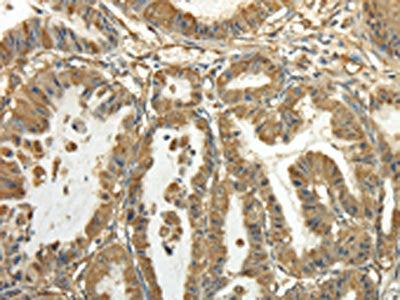 The image on the left is immunohistochemistry of paraffin-embedded Human esophagus cancer tissue using TUBA1C Antibody(TUBA1C Antibody) at dilution 1/20, on the right is treated with fusion protein. (Original magnification: ×200)Rabbit anti-Human TUBA1C Polyclonal Antibody