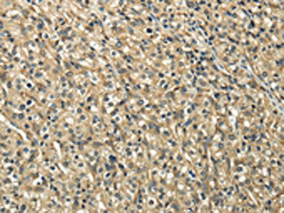The image on the left is immunohistochemistry of paraffin-embedded Human prostate cancer tissue using the antibody Antibody) at dilution 1/20, on the right is treated with fusion protein. (Original magnification: ×200)Rabbit anti-Human TUBA1C Polyclonal Antibody