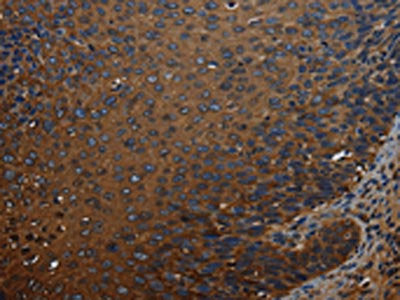 The image on the left is immunohistochemistry of paraffin-embedded Human cervical cancer tissue using the antibody Antibody) at dilution 1/50, on the right is treated with synthetic peptide. (Original magnification: ×200)