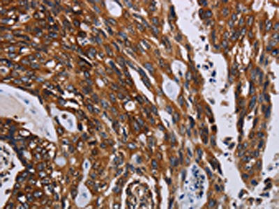 The image on the left is immunohistochemistry of paraffin-embedded Human colon cancer tissue using KARS Antibody(KARS Antibody) at dilution 1/60, on the right is treated with fusion protein. (Original magnification: ×200)