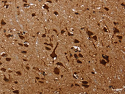 The image on the left is immunohistochemistry of paraffin-embedded Human brain tissue using the antibody Antibody) at dilution 1/60, on the right is treated with fusion protein. (Original magnification: ×200)