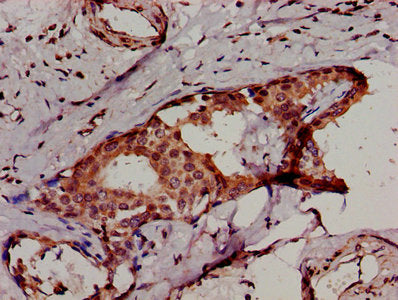IHC image of IKBKB Antibody diluted at 1:500 and staining in paraffin-embedded human breast cancer performed on a Leica BondTM system. After dewaxing and hydration, antigen retrieval was mediated by high pressure in a citrate buffer (pH 6.0). Section was blocked with 10% normal goat serum 30min at RT. Then primary antibody (1% BSA) was incubated at 4°C overnight. The primary is detected by a biotinylated secondary antibody and visualized using an HRP conjugated SP system.