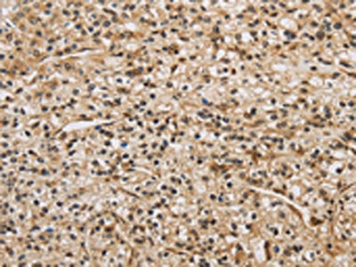 The image on the left is immunohistochemistry of paraffin-embedded Human prostate cancer tissue using BRAF Antibody(BRAF Antibody) at dilution 1/30, on the right is treated with synthetic peptide. (Original magnification: ×200)