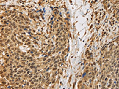 The image on the left is immunohistochemistry of paraffin-embedded Human cervical cancer tissue using the antibody Antibody) at dilution 1/30, on the right is treated with synthetic peptide. (Original magnification: ×200)