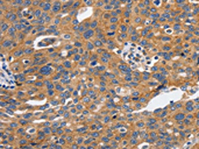The image on the left is immunohistochemistry of paraffin-embedded Human ovarian cancer tissue using CDH1 Antibody(CDH1 Antibody) at dilution 1/100, on the right is treated with synthetic peptide. (Original magnification: x200)Rabbit anti-Human CDH1 Polyclonal Antibody