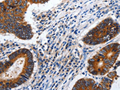 The image on the left is immunohistochemistry of paraffin-embedded Human colon cancer tissue using the antibody Antibody) at dilution 1/100, on the right is treated with synthetic peptide. (Original magnification: x200)Rabbit anti-Human CDH1 Polyclonal Antibody