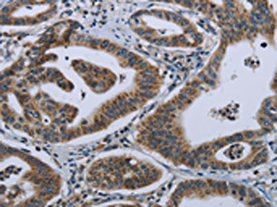 The image on the left is immunohistochemistry of paraffin-embedded Human gastic cancer tissue using the antibody Antibody) at dilution 1/50, on the right is treated with fusion protein. (Original magnification: ×200)Rabbit anti-Human GNG2 Polyclonal Antibody