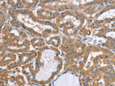 The image on the left is immunohistochemistry of paraffin-embedded Human thyroid cancer tissue using the antibody Antibody) at dilution 1/20, on the right is treated with fusion protein. (Original magnification: ×200)Rabbit anti-Human MSMB Polyclonal Antibody