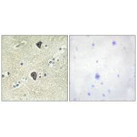 Immunohistochemical analysis of paraffin-embedded human breast carcinoma tissue using FGFR3 antibody.Rabbit anti-Human FGFR3 Polyclonal Antibody