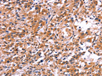 The image on the left is immunohistochemistry of paraffin-embedded Human thyroid cancer tissue using the antibody Antibody) at dilution 1/30, on the right is treated with synthetic peptide. (Original magnification: ×200)Rabbit anti-Human APMAP Polyclonal Antibody