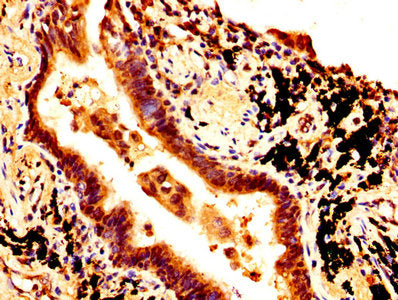 IHC image of SOX2 Antibody diluted at 1:500 and staining in paraffin-embedded human lung cancer performed on a Leica BondTM system. After dewaxing and hydration, antigen retrieval was mediated by high pressure in a citrate buffer (pH 6.0). Section was blocked with 10% normal goat serum 30min at RT. Then primary antibody (1% BSA) was incubated at 4°C overnight. The primary is detected by a biotinylated secondary antibody and visualized using an HRP conjugated SP system.Rabbit anti-Human SOX2 Polyclonal Antibody
