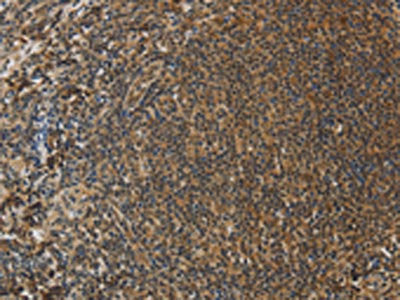 The image on the left is immunohistochemistry of paraffin-embedded Human tonsil tissue using PCP4 Antibody(PCP4 Antibody) at dilution 1/50, on the right is treated with fusion protein. (Original magnification: ×200)Rabbit anti-Human PCP4 Polyclonal Antibody