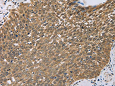 The image on the left is immunohistochemistry of paraffin-embedded Human cervical cancer tissue using the antibody Antibody) at dilution 1/50, on the right is treated with fusion protein. (Original magnification: ×200)Rabbit anti-Human PCP4 Polyclonal Antibody