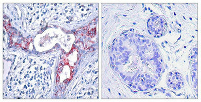 Immunohistochemical analysis of paraffin-embedded human breast carcinoma tissue using GSK3β (Phospho-Ser9) Antibody (left) or the same antibody preincubated with blocking peptide (right).Rabbit anti-Human GSK3B Polyclonal Antibody