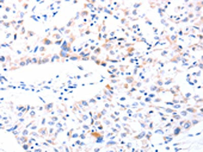The image on the left is immunohistochemistry of paraffin-embedded Human lung cancer tissue using SPAG4 Antibody(SPAG4 Antibody) at dilution 1/30, on the right is treated with synthetic peptide. (Original magnification: ×200)Rabbit anti-Human SPAG4 Polyclonal Antibody