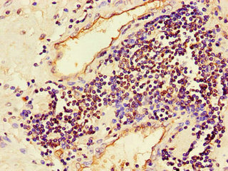 Immunohistochemistry of paraffin-embedded human prostate cancer using MAPK8 Antibody at dilution of 1:100Rabbit anti-Human MAPK8 Polyclonal Antibody