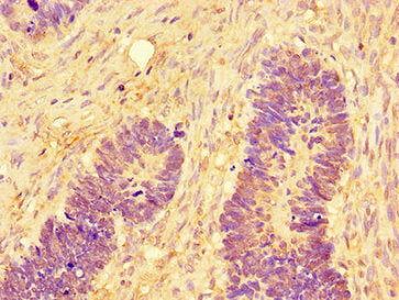 Immunohistochemistry of paraffin-embedded human ovarian cancer using MAPK8 Antibody at dilution of 1:100Rabbit anti-Human MAPK8 Polyclonal Antibody