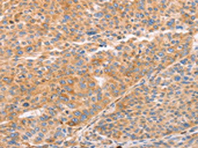 The image on the left is immunohistochemistry of paraffin-embedded Human liver cancer tissue using STK4 Antibody(STK3/STK4 Antibody) at dilution 1/70, on the right is treated with synthetic peptide. (Original magnification: ×200)Rabbit anti-Human STK4 Polyclonal Antibody