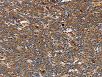 The image on the left is immunohistochemistry of paraffin-embedded Human Lymphoma tissue using the antibody Antibody) at dilution 1/70, on the right is treated with synthetic peptide. (Original magnification: ×200)Rabbit anti-Human STK4 Polyclonal Antibody