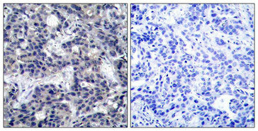 Immunohistochemical analysis of paraffin-embedded human breast carcinoma tissue using PKR(Ab-446) Antibody(left) or the same antibody preincubated with blocking peptide(right).Rabbit anti-Human EIF2AK2 Polyclonal Antibody