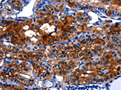 The image on the left is immunohistochemistry of paraffin-embedded Human thyroid cancer tissue using LGALS3 Antibody(LGALS3 Antibody) at dilution 1/5, on the right is treated with fusion protein. (Original magnification: ×200)