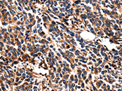 The image on the left is immunohistochemistry of paraffin-embedded Human breast cancer tissue using the antibody Antibody) at dilution 1/5, on the right is treated with fusion protein. (Original magnification: ×200)