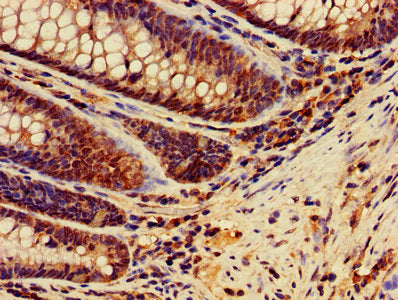 IHC image of MSH2 Antibody diluted at 1:400 and staining in paraffin-embedded human colon cancer performed on a Leica BondTM system. After dewaxing and hydration, antigen retrieval was mediated by high pressure in a citrate buffer (pH 6.0). Section was blocked with 10% normal goat serum 30min at RT. Then primary antibody (1% BSA) was incubated at 4°C overnight. The primary is detected by a biotinylated secondary antibody and visualized using an HRP conjugated SP system.Rabbit anti-Human MSH2 Polyclonal Antibody