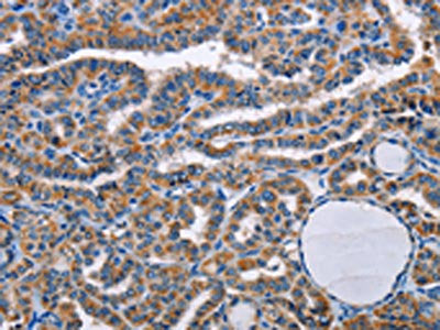 The image on the left is immunohistochemistry of paraffin-embedded Human thyroid cancer tissue using STRADB Antibody(STRADB Antibody) at dilution 1/20, on the right is treated with fusion protein. (Original magnification: ×200)Rabbit anti-Human STRADB Polyclonal Antibody