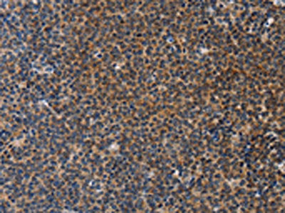The image on the left is immunohistochemistry of paraffin-embedded Human lymphoma tissue using the antibody Antibody) at dilution 1/20, on the right is treated with fusion protein. (Original magnification: ×200)Rabbit anti-Human STRADB Polyclonal Antibody