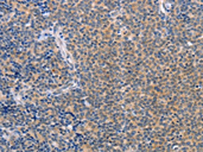 The image on the left is immunohistochemistry of paraffin-embedded Human Lymphoma tissue using the antibody  Antibody) at dilution 1/50, on the right is treated with synthetic peptide. (Original magnification: ×200)