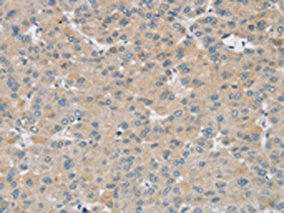 The image on the left is immunohistochemistry of paraffin-embedded Human liver cancer tissue using SMOC2 Antibody(SMOC2 Antibody) at dilution 1/30, on the right is treated with synthetic peptide. (Original magnification: ×200)Rabbit anti-Human SMOC2 Polyclonal Antibody