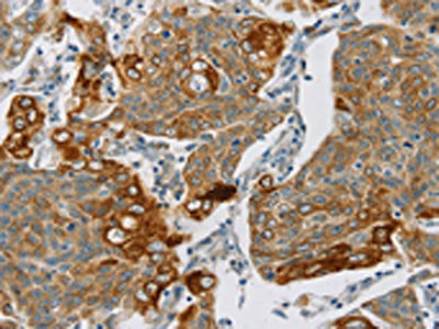 The image on the left is immunohistochemistry of paraffin-embedded Human cervical cancer tissue using the antibody Antibody) at dilution 1/30, on the right is treated with synthetic peptide. (Original magnification: ×200)Rabbit anti-Human SMOC2 Polyclonal Antibody