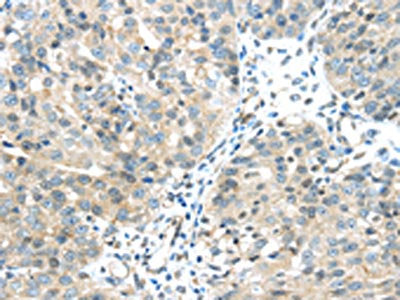 The image on the left is immunohistochemistry of paraffin-embedded Human breast cancer tissue using CHRNA1 Antibody(CHRNA1 Antibody) at dilution 1/20, on the right is treated with synthetic peptide. (Original magnification: ×200)Rabbit anti-Human CHRNA1 Polyclonal Antibody