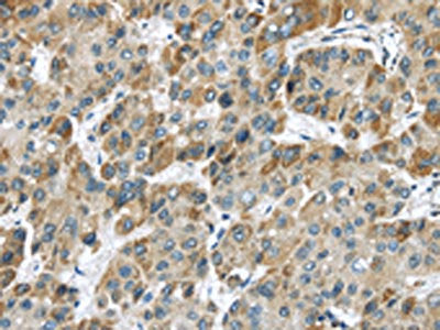 The image on the left is immunohistochemistry of paraffin-embedded Human liver cancer tissue using the antibody Antibody) at dilution 1/20, on the right is treated with synthetic peptide. (Original magnification: ×200)Rabbit anti-Human CHRNA1 Polyclonal Antibody