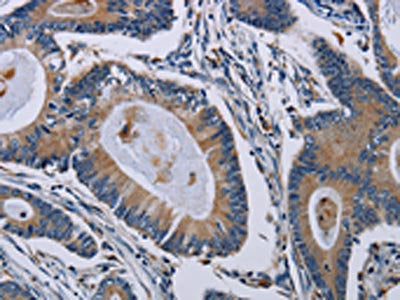 The image on the left is immunohistochemistry of paraffin-embedded Human colon cancer tissue using PCDHAC1 Antibody(PCDHAC1 Antibody) at dilution 1/50, on the right is treated with synthetic peptide. (Original magnification: ×200)Rabbit anti-Human PCDHAC1 Polyclonal Antibody