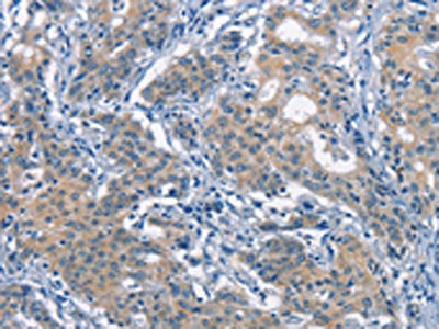 The image on the left is immunohistochemistry of paraffin-embedded Human gastric cancer tissue using CDC25B Antibody(CDC25B  Antibody) at dilution 1/50, on the right is treated with synthetic peptide. (Original magnification: ×200)Rabbit anti-Human CDC25B Polyclonal Antibody