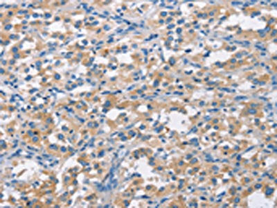 The image on the left is immunohistochemistry of paraffin-embedded Human thyroid cancer tissue using the antibody  Antibody) at dilution 1/50, on the right is treated with synthetic peptide. (Original magnification: ×200)Rabbit anti-Human CDC25B Polyclonal Antibody