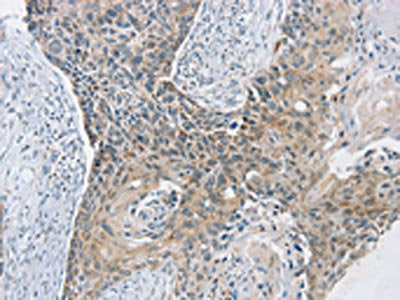 The image on the left is immunohistochemistry of paraffin-embedded Human esophagus cancer tissue using SCD Antibody(SCD Antibody) at dilution 1/20, on the right is treated with synthetic peptide. (Original magnification: ×200)Rabbit anti-Human SCD Polyclonal Antibody