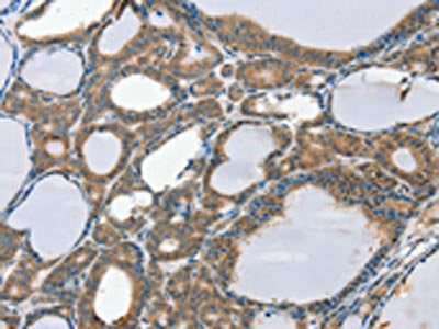 The image on the left is immunohistochemistry of paraffin-embedded Human thyroid cancer tissue using the antibody Antibody) at dilution 1/20, on the right is treated with synthetic peptide. (Original magnification: ×200)Rabbit anti-Human SCD Polyclonal Antibody