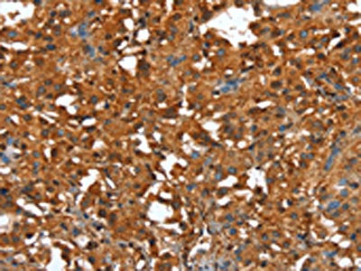 The image on the left is immunohistochemistry of paraffin-embedded Human thyroid cancer tissue using CTBP1 Antibody(CTBP1 Antibody) at dilution 1/40, on the right is treated with synthetic peptide. (Original magnification: ×200)Rabbit anti-Human CTBP1 Polyclonal Antibody
