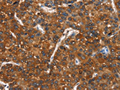 The image on the left is immunohistochemistry of paraffin-embedded Human liver cancer tissue using the antibody Antibody) at dilution 1/40, on the right is treated with synthetic peptide. (Original magnification: ×200)Rabbit anti-Human CTBP1 Polyclonal Antibody