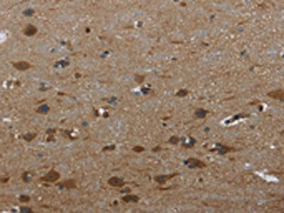The image on the left is immunohistochemistry of paraffin-embedded Human brain  tissue using GYS1 Antibody(GYS1 Antibody) at dilution 1/40, on the right is treated with fusion protein. (Original magnification: ×200)Rabbit anti-Human GYS1 Polyclonal Antibody