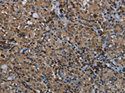 The image on the left is immunohistochemistry of paraffin-embedded Human thyroid cancer tissue using the antibody Antibody) at dilution 1/40, on the right is treated with fusion protein. (Original magnification: ×200)Rabbit anti-Human GYS1 Polyclonal Antibody