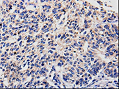 The image is immunohistochemistry of paraffin-embedded Human lung cancer tissue using RAB22A Antibody(RAB22A Antibody) at dilution 1/100. (Original magnification: ×200)Rabbit anti-Human RAB22A Polyclonal Antibody