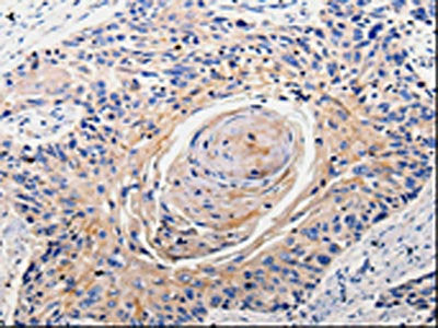 The image is immunohistochemistry of paraffin-embedded Human esophagus cancer tissue using the antibody Antibody) at dilution 1/100. (Original magnification: ×200)Rabbit anti-Human RAB22A Polyclonal Antibody