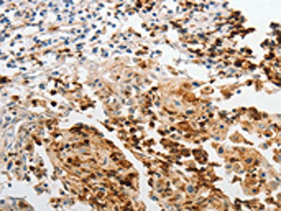 The image on the left is immunohistochemistry of paraffin-embedded Human cervical cancer tissue using LCN2 Antibody(LCN2 Antibody) at dilution 1/60, on the right is treated with synthetic peptide. (Original magnification: ×200)