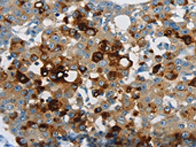 The image on the left is immunohistochemistry of paraffin-embedded Human breast cancer tissue using the antibody Antibody) at dilution 1/60, on the right is treated with synthetic peptide. (Original magnification: ×200)