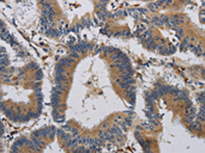The image on the left is immunohistochemistry of paraffin-embedded Human colon cancer tissue using CCR2 Antibody(CCR2 Antibody) at dilution 1/20, on the right is treated with synthetic peptide. (Original magnification: ×200)Rabbit anti-Human CCR2 Polyclonal Antibody